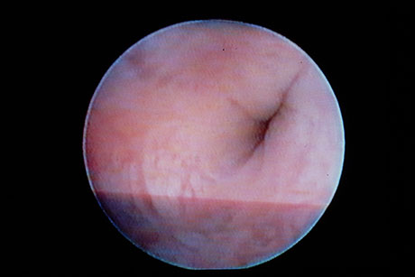 Bilde 5: Sialoskopisk funn med «sphinkter» i ductus submandibularis.